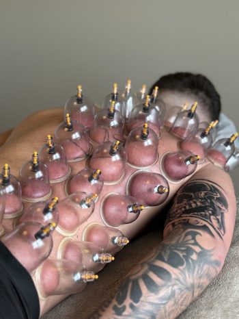 cupping1
